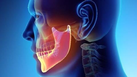 صادرات ایمپلنت های فك و صورت ایرانی به 4 كشور